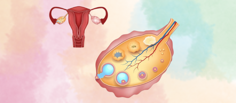 Ovulation Induction