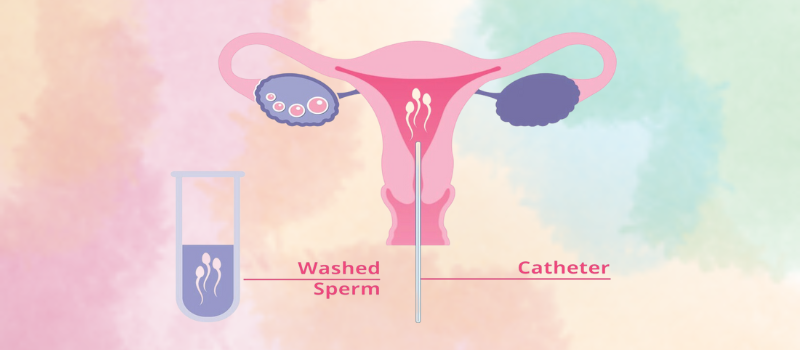 Intra-Uterine Insemination