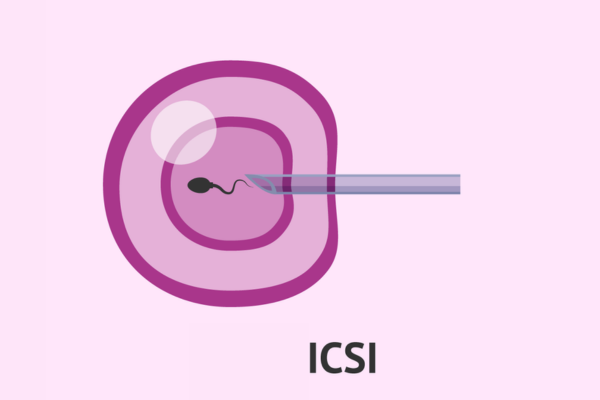 Exploring Intracytoplasmic Sperm Injection Treatment