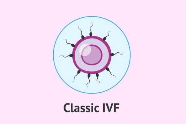 Exploring in vitro fertilization (IVF) Treatment