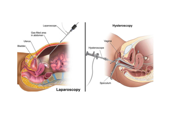  Fertility Care with Hysteroscopy and Laparoscopy