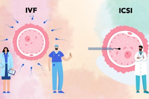 Exploring Intracytoplasmic Sperm Injection Treatment