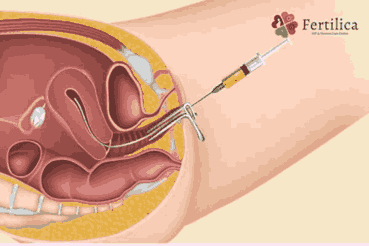 IUI Treatment