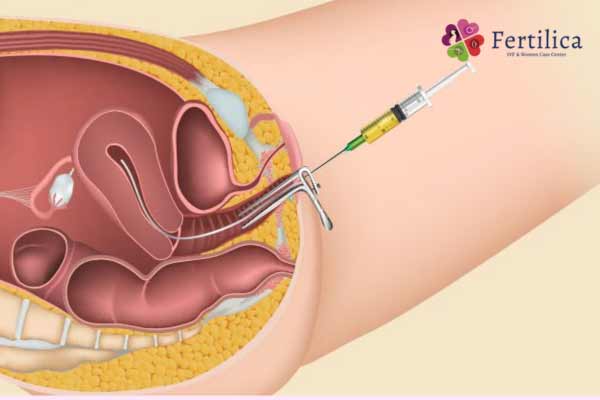 Exploring Intrauterine Insemination (IUI) Treatment