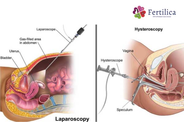 Hysteroscopy And Laparoscopy 